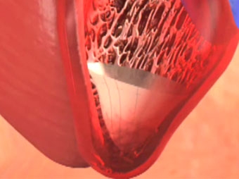CardioKinetix secures financing to develop ventricular partitioning device