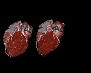 Cardiac CT slices ED costs for patients with chest pain