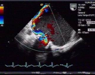 Fourth generation bio- prosthetic heart valve now available in India