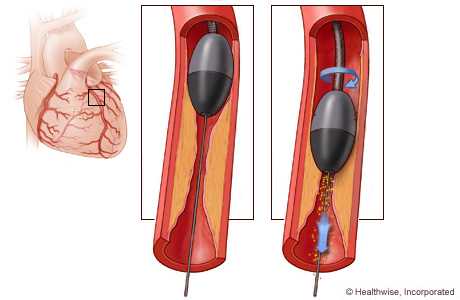 Wockhardt Hospital, Nashik Carries out Rotablator Surgery on Heart Patient