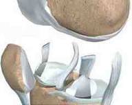 Device to print implantable cartilage developed