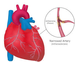 New App Diagnoses Heart Attacks