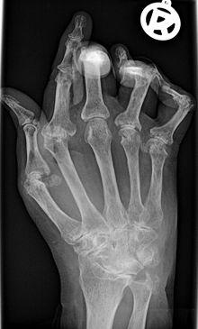 Updated Rheumatoid Arthritis Management Recommendations Issued By EULAR