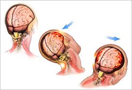 New way to measure cumulative effect of head hits in football
