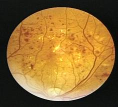 Potential New Approach to Prevent Diabetes-Induced Birth Defects