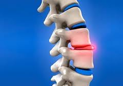 Herniated disc