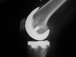 The Societal Benefits of Knee Replacement Surgery Highlighted by New Health Economics Study