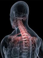 Carbon ion Radiotherapy Safe and Effective for Treating Inoperable Spinal Tumors