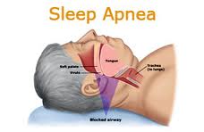 Sleep Apnea Sufferers May Benefit From New Surgical Tool