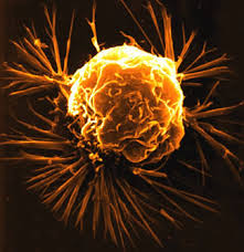 Depletion of FoxM1 in Prostate Epithelial Cells Inhibits Tumor cell Proliferation – Possible New Approach to Prostate Cancer Treatment
