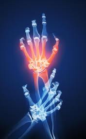 Premature aging of immune cells present in joints of kids with chronic arthritis