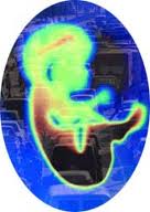 Potential New Approach to Prevent Diabetes-Induced Birth Defects
