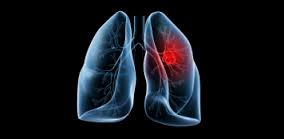 Chemotherapy Helps Elderly Patients With Small Cell Lung Cancer