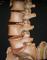 Decompression Surgery for ‘Arthritis of the Spine’ Prevents Paralysis