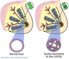 New trial to help healthy women avoid unnecessary breast operations, UK