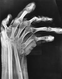 Bone destruction in diseases: new target identified for prevention