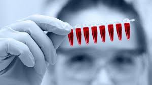 SRL launches ST2 lab test to identify high risk heart failure