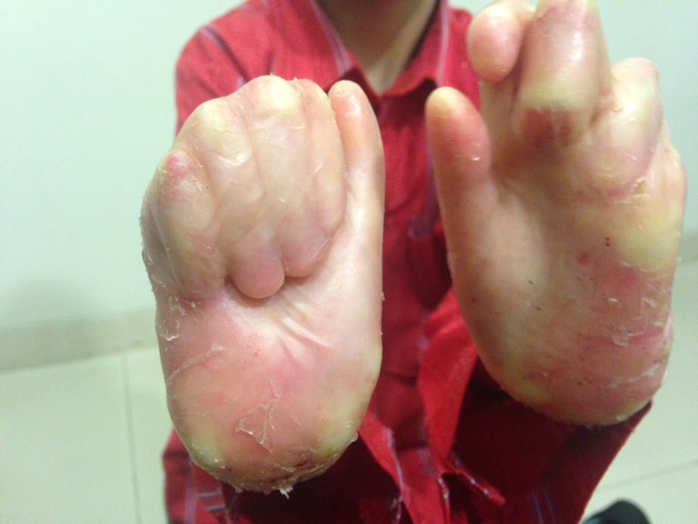 Doctors at Fortis give 10 year old Iraqi boy a new lease of life