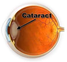 Vitamin E and Selenium Fail to Prevent Cataracts