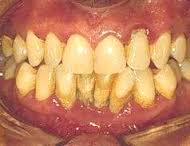 Severe periodontitis: Sixth most usual health condition in the world
