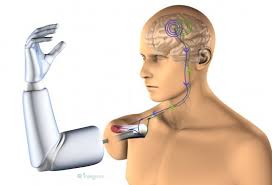 Prosthetic arm controlled by brain successfully developed