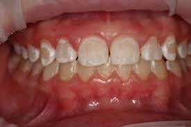 Tooth decay affects 12% of three-year-olds, says survey