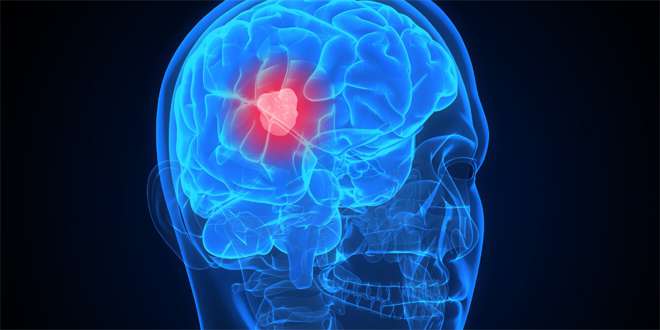 Datar Genetics Collaborates with AHERF on Biopsy for Brain Tumors
