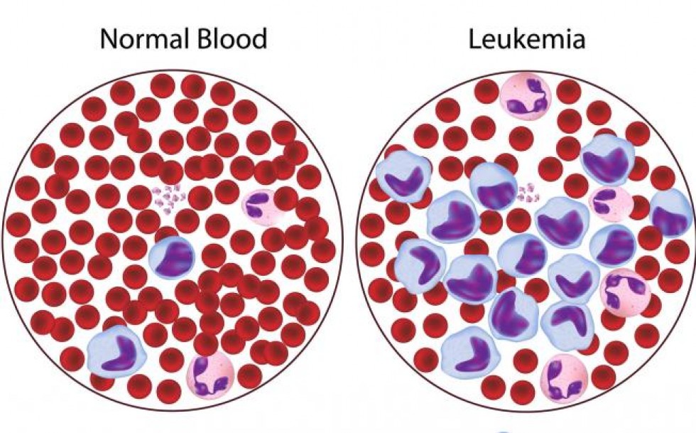 Wonder Drug Gleevec Promises Life to Cancer Patients