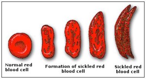 sickle-cell-anemia