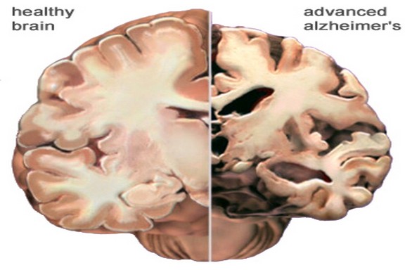 Alzheimer To Be Detected Via Blood Test