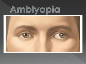 amblyopia-