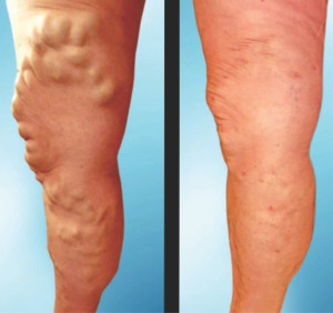 Amandeep Hospital & Clinics bring Laser Treatment for Varicose Veins for the first time in Amritsar, Punjab