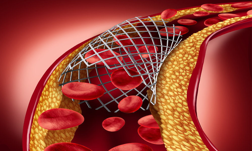 Clinical trial shows made in India novel stent is safe for patients
