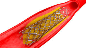 stent