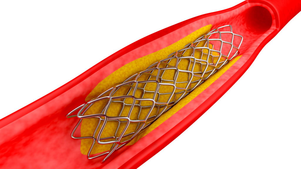 Hospitals ordered to separately disclose cost of coronary stents