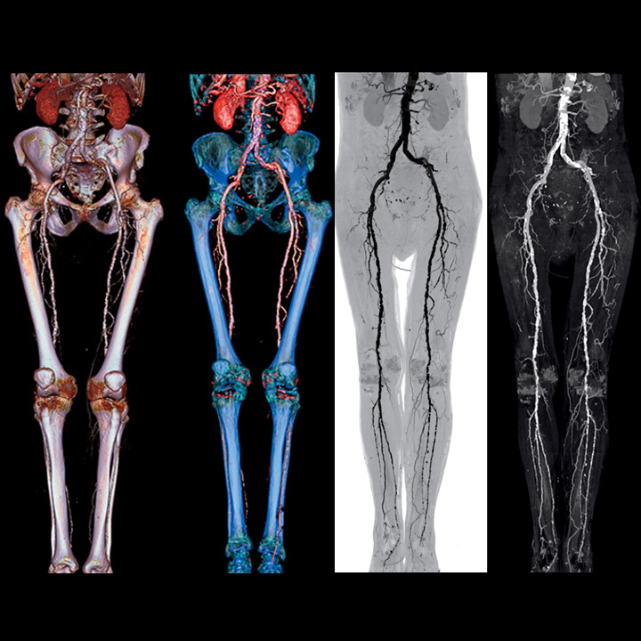 ‘CT angiography better predicts cardiac risk for patients with chest pain’