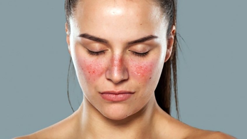 US scientists identify potential cause for lupus