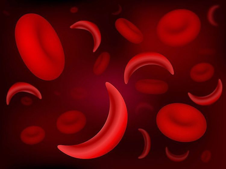 New computer models give hope to millions of sickle cell patients