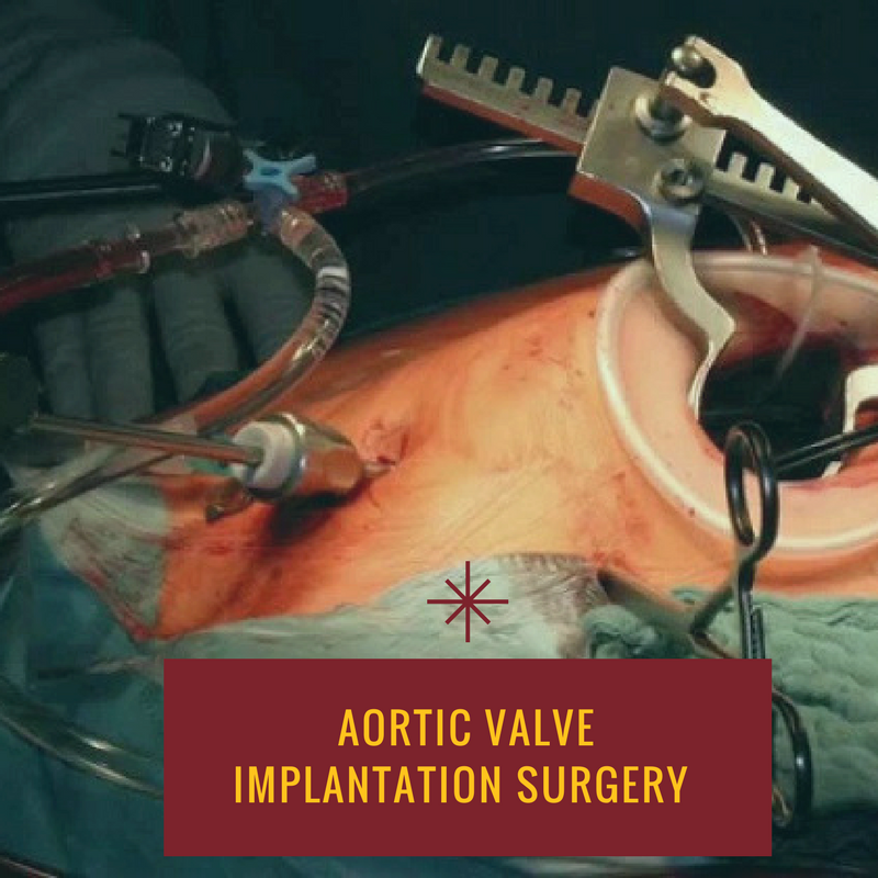 AMRI Hospital conducts eastern Indias first Trans Aortic Valve implantation surgery