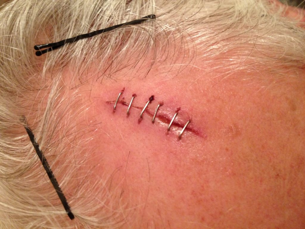 Can a sealant inspired by slugs be the future of sutures and staples?