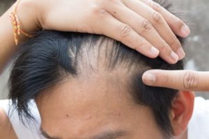 Hair Transplant