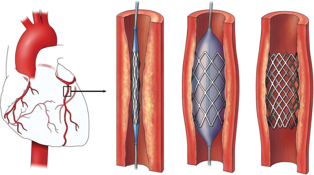 Indigenous coronary stents as safe and efficacious as foreign ones: Study