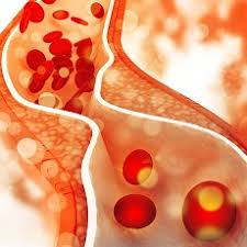 Managing cholesterol may reduce Alzheimer’s risk