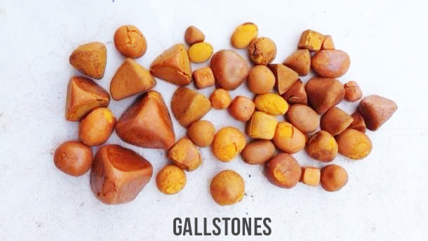 Gall bladder stones: All you need to know