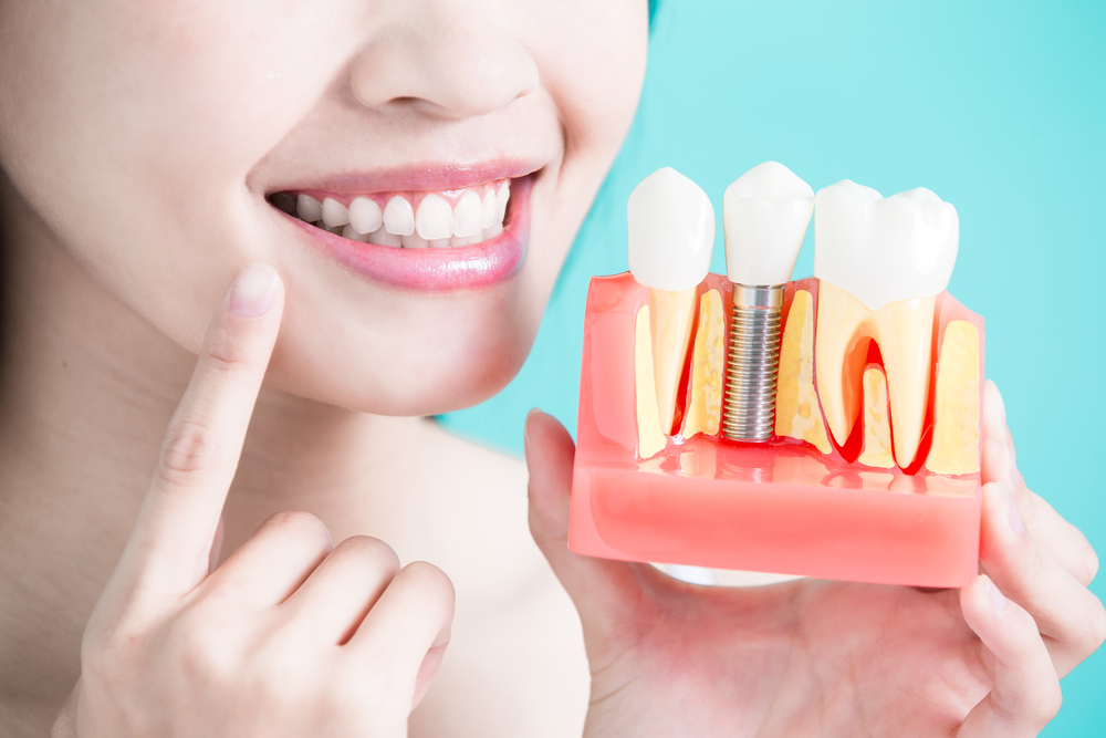 How dental implants bolsters your self-esteem?