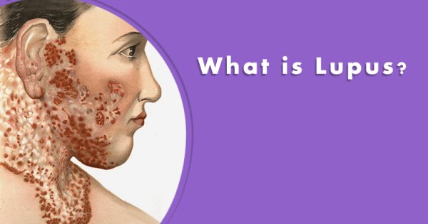 Lupus or chronic autoimmune condition–Causes, symptoms, and treatment