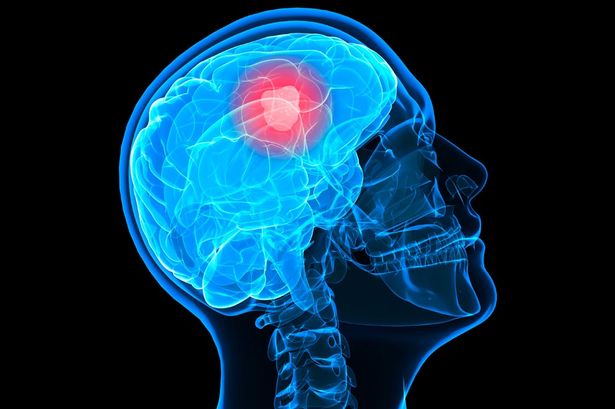 Explained: Know all about malignant tumour