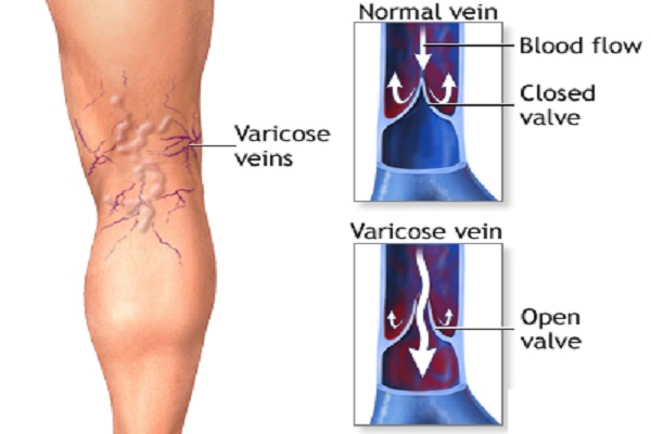 Some of the Fashion outfits can ruin your Veins; Know-how from the expert