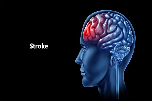Understanding incidences of Stroke young adults