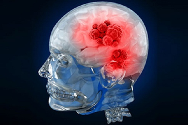 Brain tumor surgery: Maximizing results with new-age technology and expertise